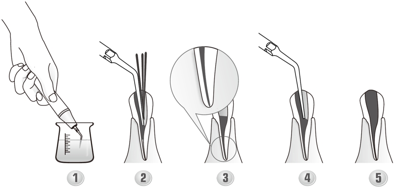 Сфера применения наконечника для скалера